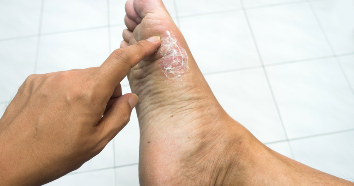 Foot Eczema vs Athlete's Foot